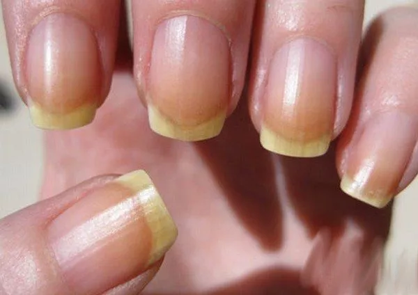 Ongle-jaune-jpg