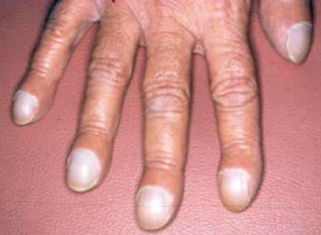 ongle bombé-min