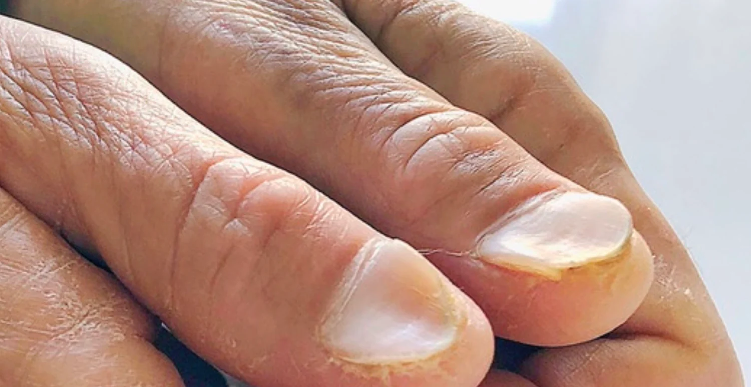 ongle carrence de fer